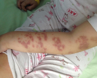 女童手臂的紅疹變成青紫色。 網上圖片