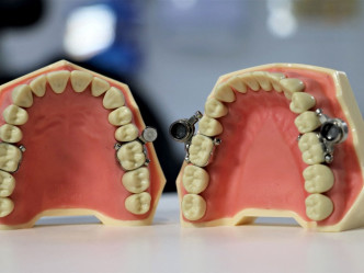 纽西兰研究人员研发出1种新的减肥装置，将磁铁安装在人的牙齿上，使人们不能容易张口。纽西兰奥塔哥大学图片