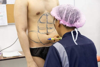 医护人员会先在先造型的肚腩上画出理想的腹肌形状。(图：Masterpiece Hospital fb )