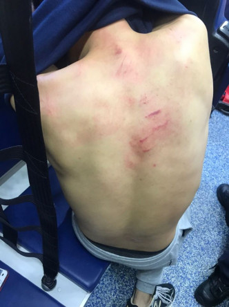 黃嘉浩的背部及手臂等亦有傷痕。黃嘉浩FB圖片