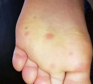 一些新冠肺炎患者的脚上出现了「类似水痘或麻疹」的病变。(网图)