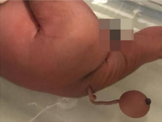男婴尾部生出一条12公分的尾巴连肉球。图：Journal of Pediatric Surgery Case Reports