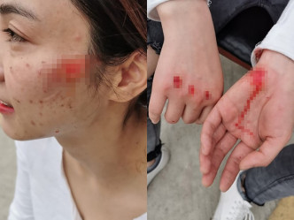 女警捉拿疑犯被拖拽數米倒地，臉部、手部多處負傷。 網上圖片