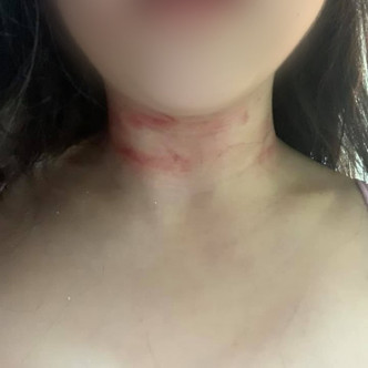 女事主在网上展示颈部出现两条明显红痕。fb图片