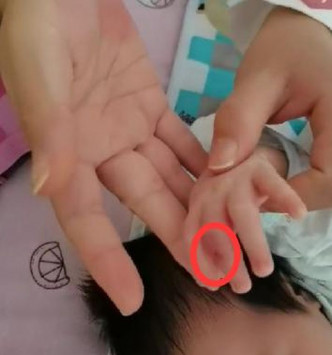 女嬰的下巴、嘴角和左手的手指均有傷口。