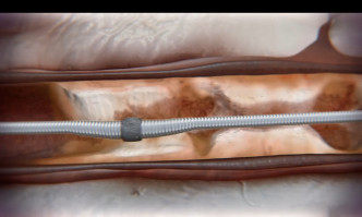 360心臓动脉粥样硬化切除器可磨走钙化物。