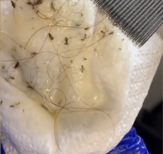 工作人員用梳刷出大量頭蝨。網上截圖