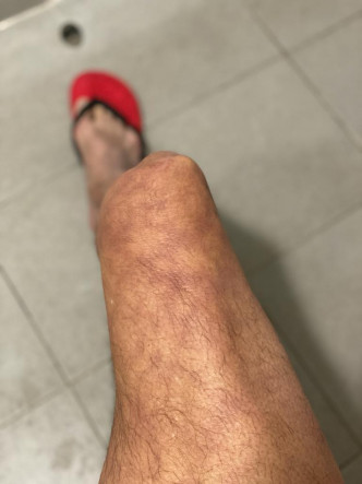 邓达智入院后，指自己的脚嘅肤色「红红白白，变晒色」。