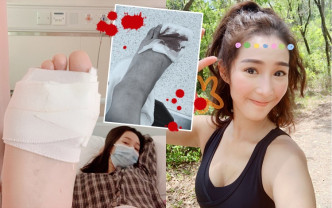 吴嘉仪在社交网发文透露不慎受伤。
