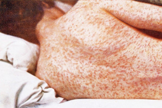 日本出現風疹爆發。網上圖片