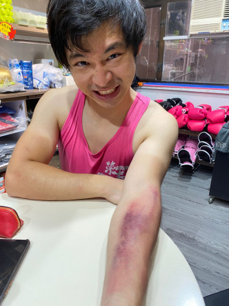 傷痕纍纍

林作話打拳受傷難免，但冇諗過喺安全保護唔足夠情況下打拳，後果有幾嚴重。