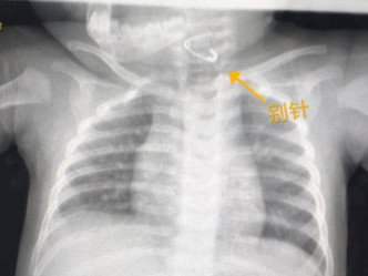 在X光檢查中發現，女嬰的確將扣針吞下。網圖