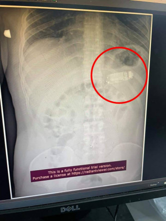 X光片顯示男子胃中有部手機（紅圈示）。互聯網圖片