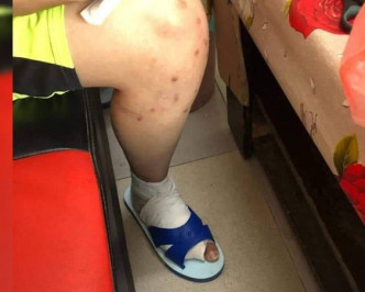腳踝也因被虐打受傷。(網圖)