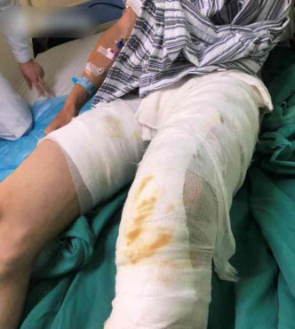 男子雙腿和手多處被燒傷。網圖