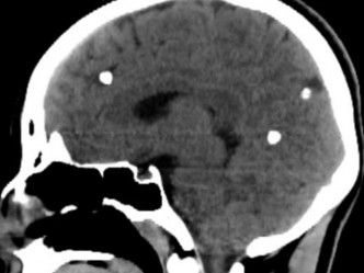 检查发现女儿脑内藏有3个肉芽肿「脑囊虫」，经医生手术成功取出。福建省卫生厅图片