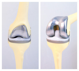 寶血醫院（明愛）骨科醫生用一套人工關節為病人置換全膝關節，此人工關節由鈷鉻合金製造，堅硬耐用，使用期可長達二十年。