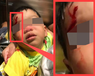 男童被「射穿頭」血流披面。