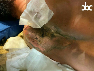 一名急救义工在铜锣湾被催泪弹灼伤后背。城市广播图片