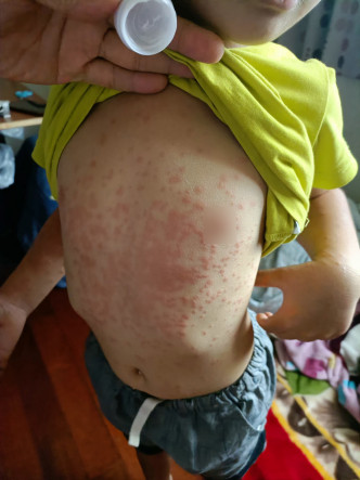 患者皮膚會出現紅疹及痕癢。(活力澎湖公益平台FB圖片)
