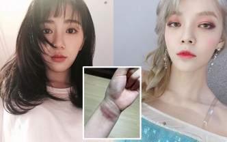 珉娥（左）发文控诉10年来受尽智珉欺凌，并贴左手腕伤疤照。
