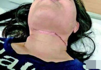 張婦上頸部的傷口深15毫米縫了30多針。網圖