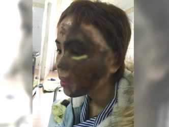 越南男警懷疑妻子出軌潑強酸毀容。網上圖片