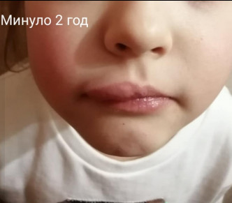 乌克兰6岁女童睇牙医后嘴巴异常肿胀。（网图）