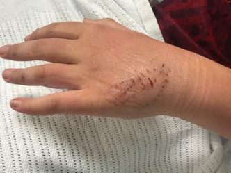 傑克森的手被蟒蛇咬傷。網上圖片