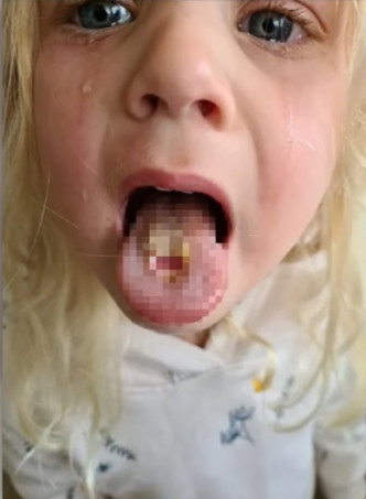 媽媽由於太過氣憤，便將女兒舌頭起泡的照片在網上公開。