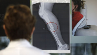 米兰一家医院展出遭受暴力对待的女子伤势X光片。AP
