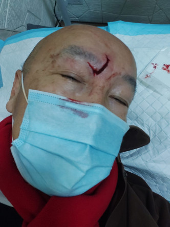 张之珏今晨出门时却不慎在酒店仆倒，撞至左眼眼角有一条逾两寸长的伤口。
