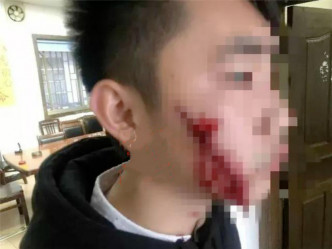 男友脸部被割伤。网上图片