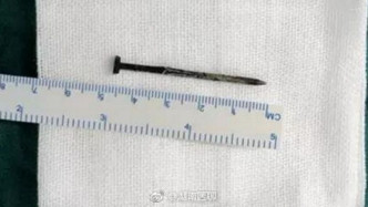 鐵釘長達4.7厘米，且有生銹痕迹。圖：湖南醫聊微博