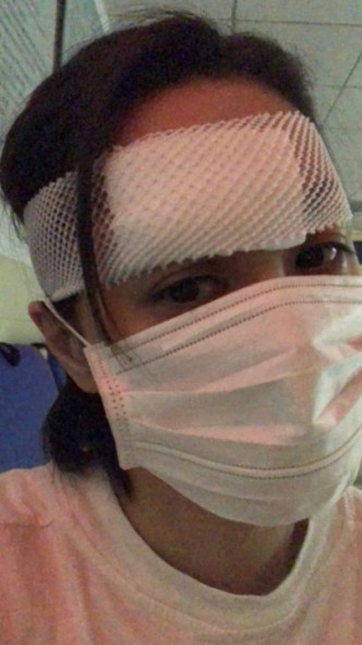 阿娇于本月7日凌晨在厦门下榻酒店房中，因不慎跌倒撞爆右边眉骨。