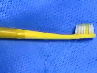 医生以胃镜手术将牙刷取出。影片截图