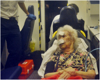 老妇面部受伤，清醒被送往东区医院治理。