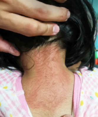 3歲女童頸部肩膀出紅疹。市民圖片