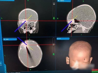 腦部掃描顯示，4cm長的碎片穿過眼眶，卡在眶壁頭骨。互聯網圖片