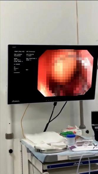 醫生用電子結腸鏡在直腸看見了麵粉棍。互聯網圖片