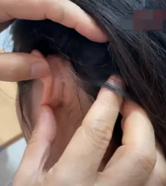 医生手术中利用女子耳后皮肤对左侧睑板进行重。网图