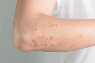 濕疹是常見的都市人皮膚病，嚴重患者有一定的生活壓力，甚或受到歧視目光。網圖