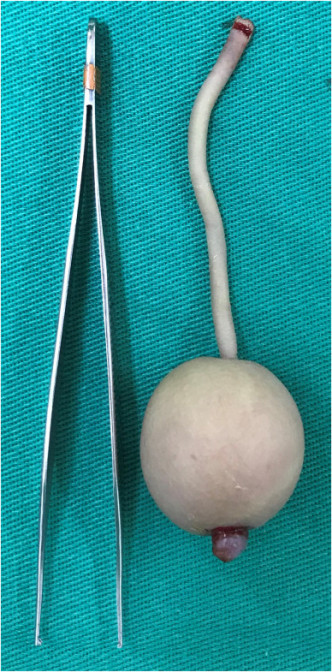 醫生為男嬰進行尾巴切除手術。圖：Journal of Pediatric Surgery Case Reports