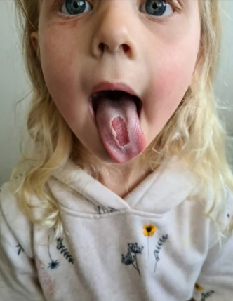 妈妈由于太过气愤，便将女儿舌头起泡的照片在网上公开。