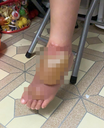 一年前小朋友腳背剛燙傷時起水泡的情況。「公務員secrets」Facebook專頁相片