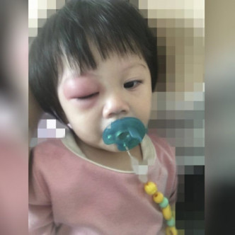 台灣一名媽媽貼文分享，指女兒被蚊叮到眼皮，15個小時內變眼腫。(網圖)