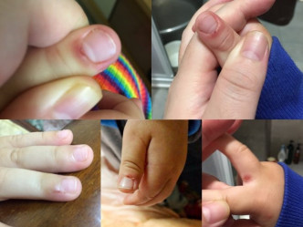 男童出現搣手指搣到流血、拔頭髮、撞頭症狀。網圖