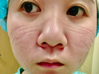 妻子因为工作缘故需长时间戴口罩，结果导致满脸口罩痕。网图