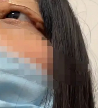 手术失误令女子左眼无法闭合。网图