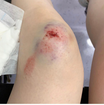 Mag展示膝盖的大片瘀伤。